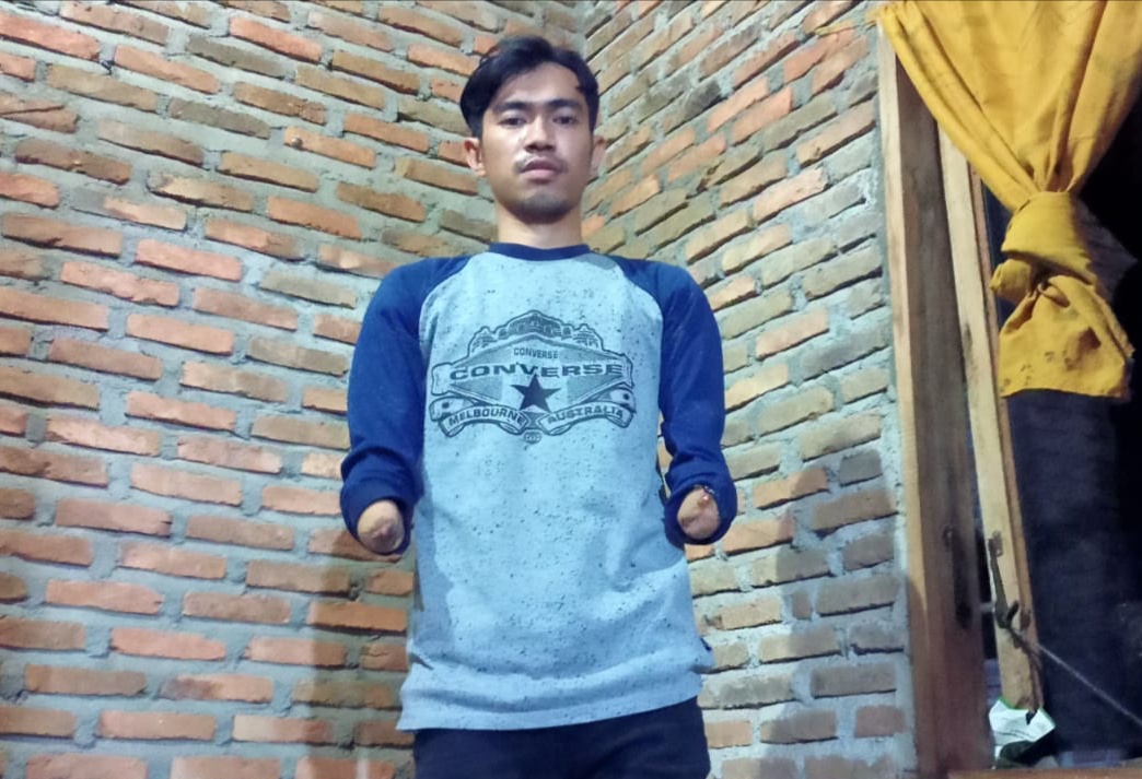 Mengalami Kecelakaan Saat Kerja, Eryad Hafia Berharap Bantuan Tangan Palsu